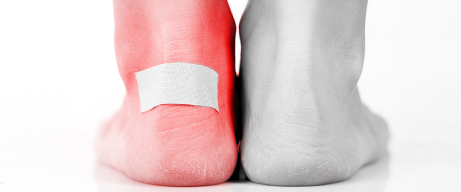 Diabetes and feet – Blisters Symptoms